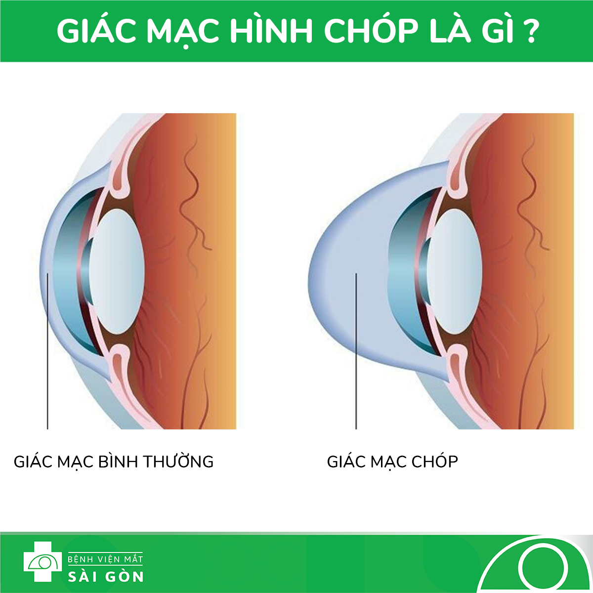 Phân biệt triệu chứng bệnh giác mạc chóp với cận loạn thị