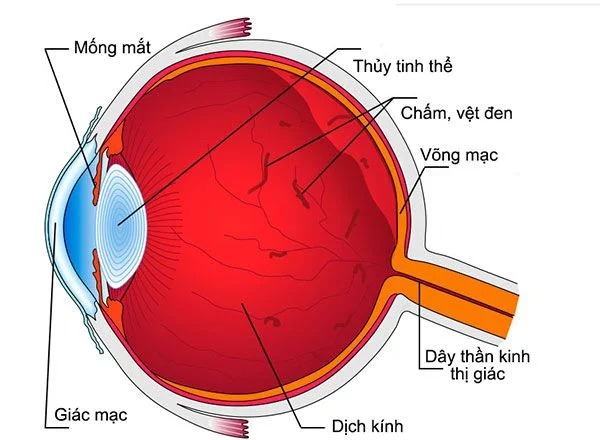 Vẩn đục dịch kính: Nguyên nhân, triệu chứng và cách điều trị