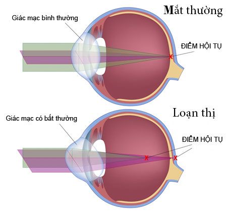 Các Yếu Tố Ảnh Hưởng Đến Trục Loạn Thị