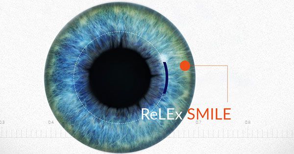 Relex smile – Kỹ thuật chữa tật khúc xạ tiên tiến nhất hiện nay